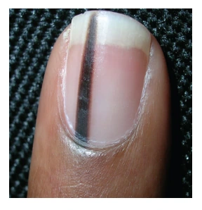 Close image of Pigmented Nail Lesions